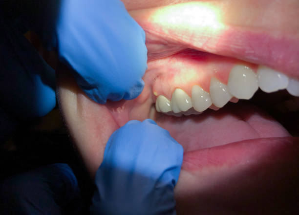 Best Emergency Gum Treatment in Laurel Lake, NJ